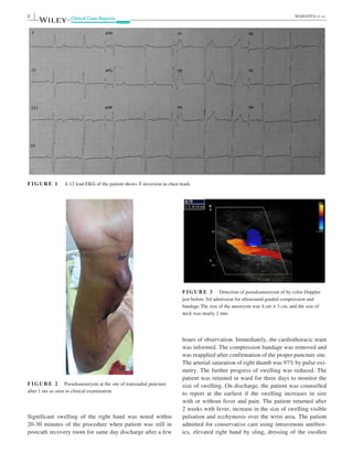 Radial artery pseudoaneurysm | PDF