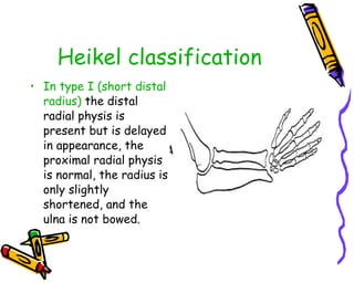 Heikel classification In type I (short distal radius)  the distal radial physis is present but is delayed in appearance, the proximal radial physis is normal, the radius is only slightly shortened, and the ulna is not bowed.  