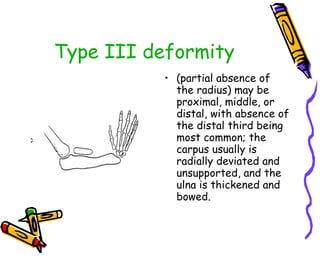 Type III deformity (partial absence of the radius) may be proximal, middle, or distal, with absence of the distal third being most common; the carpus usually is radially deviated and unsupported, and the ulna is thickened and bowed.  