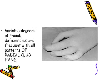 Variable degrees of thumb deficiencies are frequent with all patterns OF RADIAL CLUB HAND 