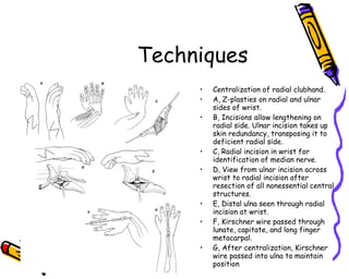 Techniques Centralization of radial clubhand. A, Z-plasties on radial and ulnar sides of wrist.  B, Incisions allow lengthening on radial side. Ulnar incision takes up skin redundancy, transposing it to deficient radial side.  C, Radial incision in wrist for identification of median nerve.  D, View from ulnar incision across wrist to radial incision after resection of all nonessential central structures.  E, Distal ulna seen through radial incision at wrist.  F, Kirschner wire passed through lunate, capitate, and long finger metacarpal.  G, After centralization, Kirschner wire passed into ulna to maintain position  