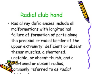 Radial club hand Radial ray deficiencies include all malformations with longitudinal failure of formation of parts along the preaxial or radial border of the upper extremity: deficient or absent thenar muscles, a shortened, unstable, or absent thumb, and a shortened or absent radius, commonly referred to as  radial clubhand   