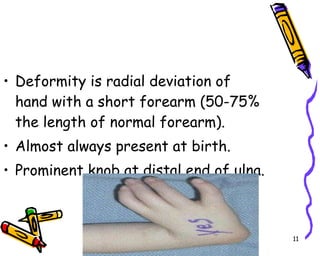Deformity is radial deviation of hand with a short forearm (50-75% the length of normal forearm). Almost always present at birth. Prominent knob at distal end of ulna. 