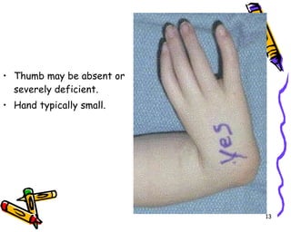 Thumb may be absent or severely deficient. Hand typically small. 