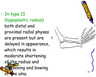 In type II (hypoplastic radius)  both distal and proximal radial physes are present but are delayed in appearance, which results in moderate shortening of the radius and thickening and bowing of the ulna.  