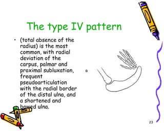The type IV pattern (total absence of the radius) is the most common, with radial deviation of the carpus, palmar and proximal subluxation, frequent pseudoarticulation with the radial border of the distal ulna, and a shortened and bowed ulna.  