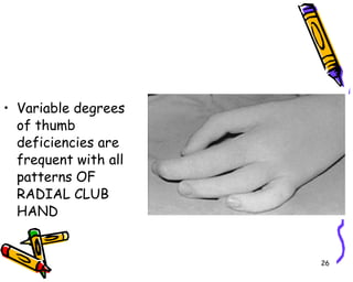 Variable degrees of thumb deficiencies are frequent with all patterns OF RADIAL CLUB HAND 