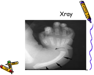 Xray 