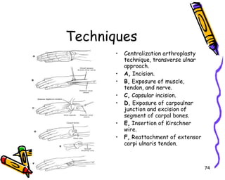 Techniques Centralization arthroplasty technique, transverse ulnar approach. A,  Incision.  B,  Exposure of muscle, tendon, and nerve.  C,  Capsular incision.  D,  Exposure of carpoulnar junction and excision of segment of carpal bones.  E,  Insertion of Kirschner wire.  F,  Reattachment of extensor carpi ulnaris tendon.  