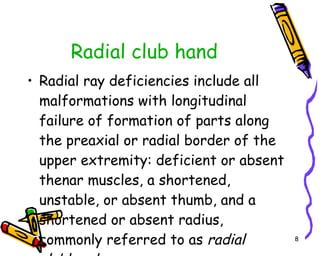 Radial club hand Radial ray deficiencies include all malformations with longitudinal failure of formation of parts along the preaxial or radial border of the upper extremity: deficient or absent thenar muscles, a shortened, unstable, or absent thumb, and a shortened or absent radius, commonly referred to as  radial clubhand   