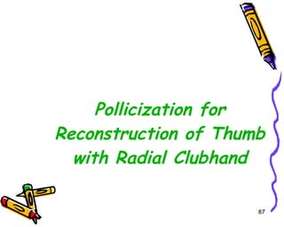Pollicization for Reconstruction of Thumb with Radial Clubhand 