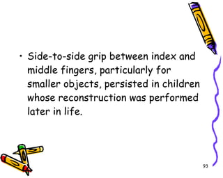 Side-to-side grip between index and middle fingers, particularly for smaller objects, persisted in children whose reconstruction was performed later in life.  