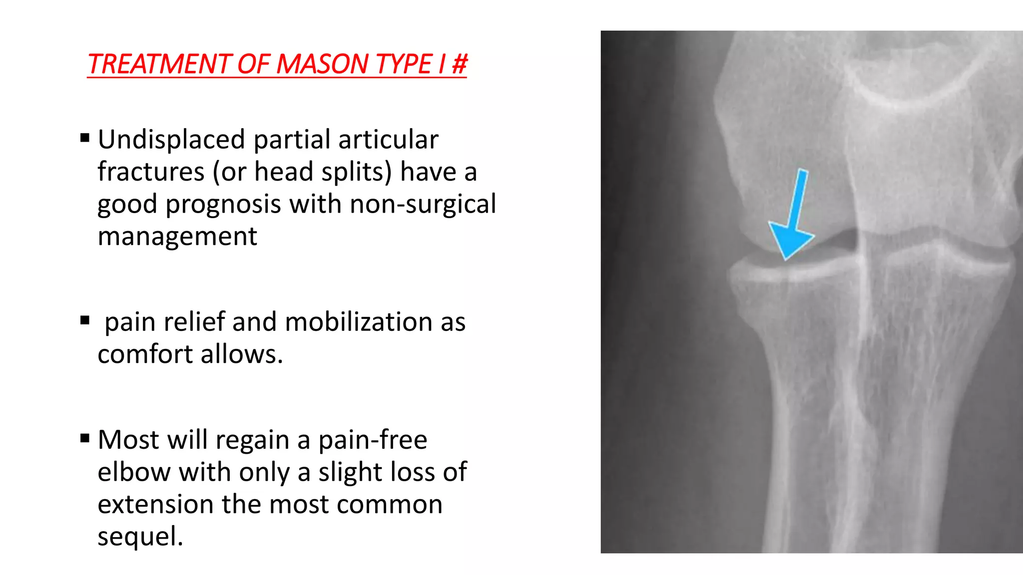 Radial head fracture | PPTX