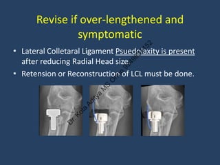 Radial Head Replacement - Surgical Tips and Tricks - Dr Kota Aditya | PDF