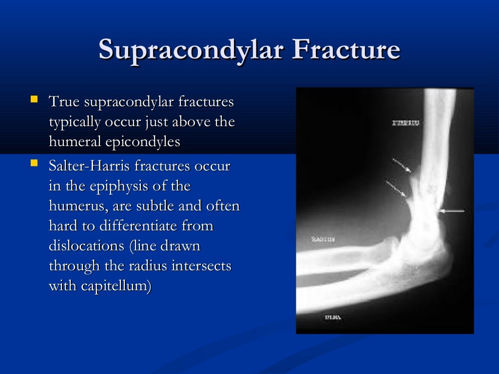 Radial head subluxation “nursemaids’ elbow”