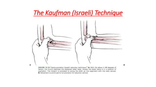 The Kaufman (Israeli) Technique
 