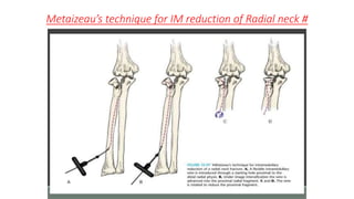 Metaizeau’s technique for IM reduction of Radial neck #
 