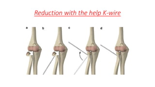 Reduction with the help K-wire
 