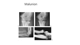 Radial neck fracture | PPTX