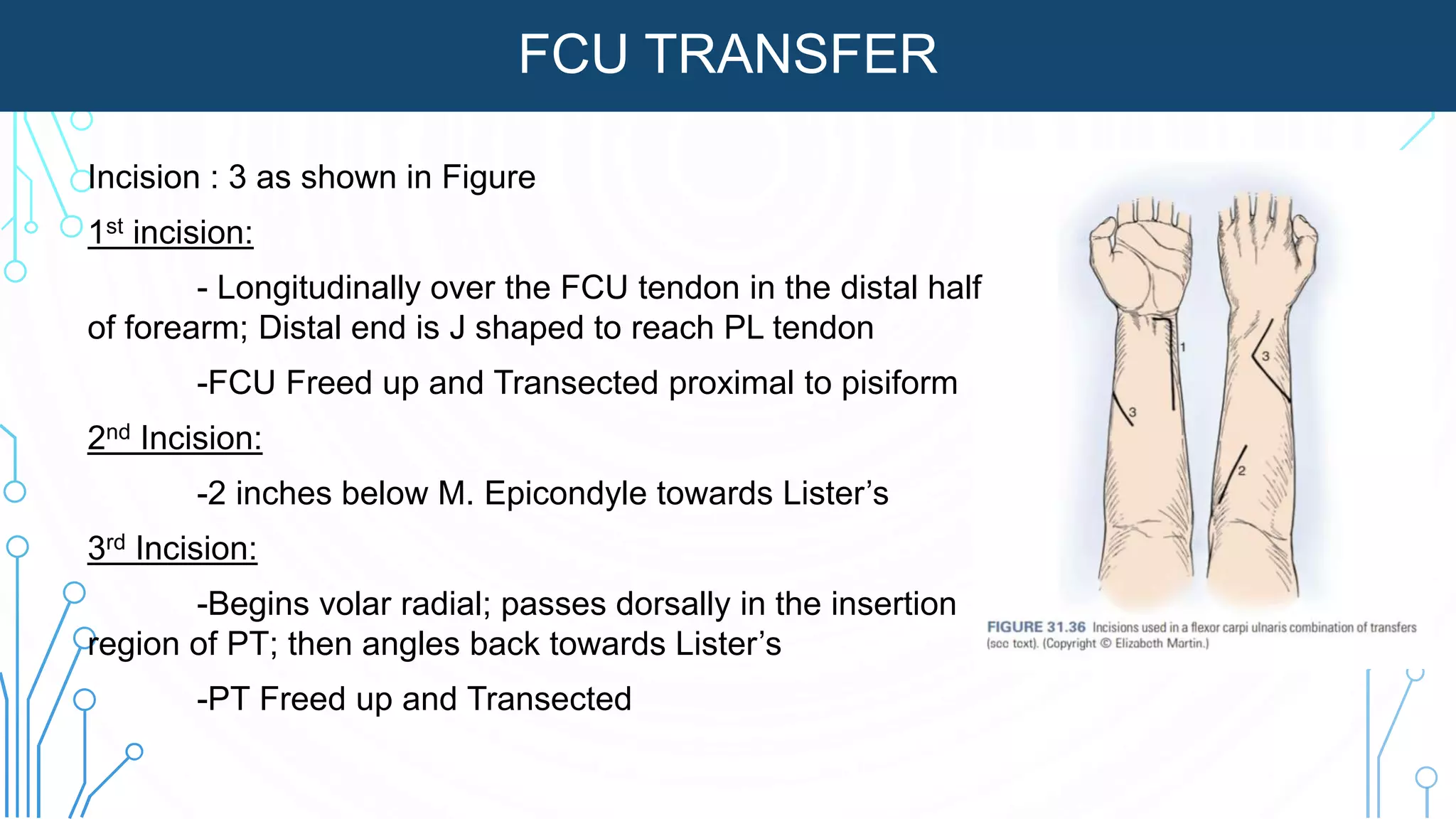 FCU TRANSFER
Incision : 3 as shown in Figure
1st incision:
- Longitudinally over the FCU tendon in the distal half
of forearm; Distal end is J shaped to reach PL tendon
-FCU Freed up and Transected proximal to pisiform
2nd Incision:
-2 inches below M. Epicondyle towards Lister’s
3rd Incision:
-Begins volar radial; passes dorsally in the insertion
region of PT; then angles back towards Lister’s
-PT Freed up and Transected
 