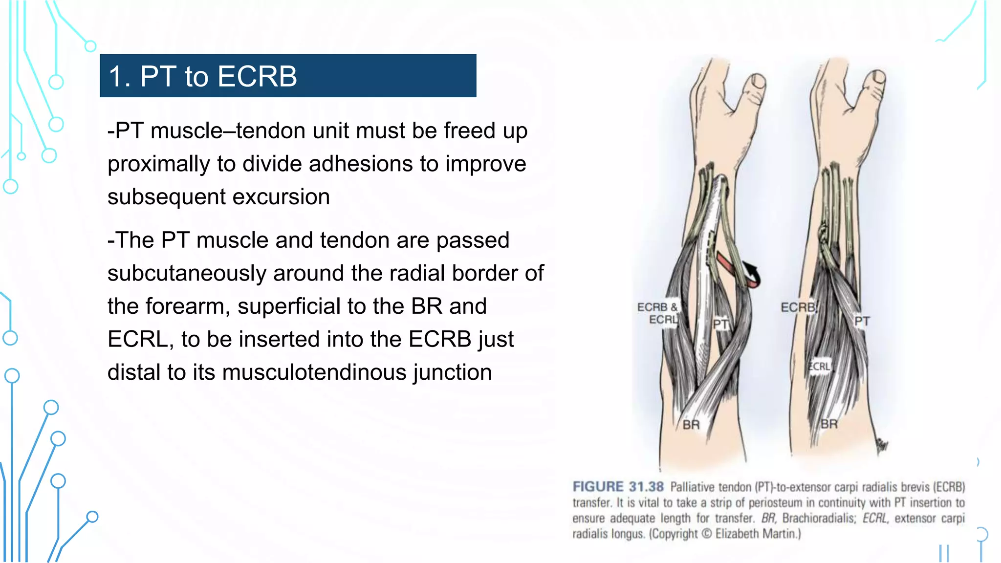 -PT muscle–tendon unit must be freed up
proximally to divide adhesions to improve
subsequent excursion
-The PT muscle and tendon are passed
subcutaneously around the radial border of
the forearm, superficial to the BR and
ECRL, to be inserted into the ECRB just
distal to its musculotendinous junction
1. PT to ECRB
 