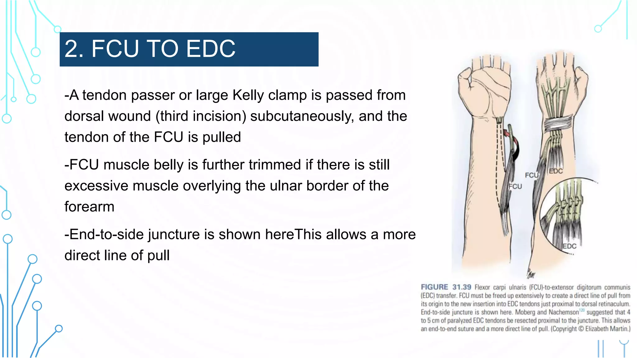 2. FCU TO EDC
-A tendon passer or large Kelly clamp is passed from
dorsal wound (third incision) subcutaneously, and the
tendon of the FCU is pulled
-FCU muscle belly is further trimmed if there is still
excessive muscle overlying the ulnar border of the
forearm
-End-to-side juncture is shown hereThis allows a more
direct line of pull
 