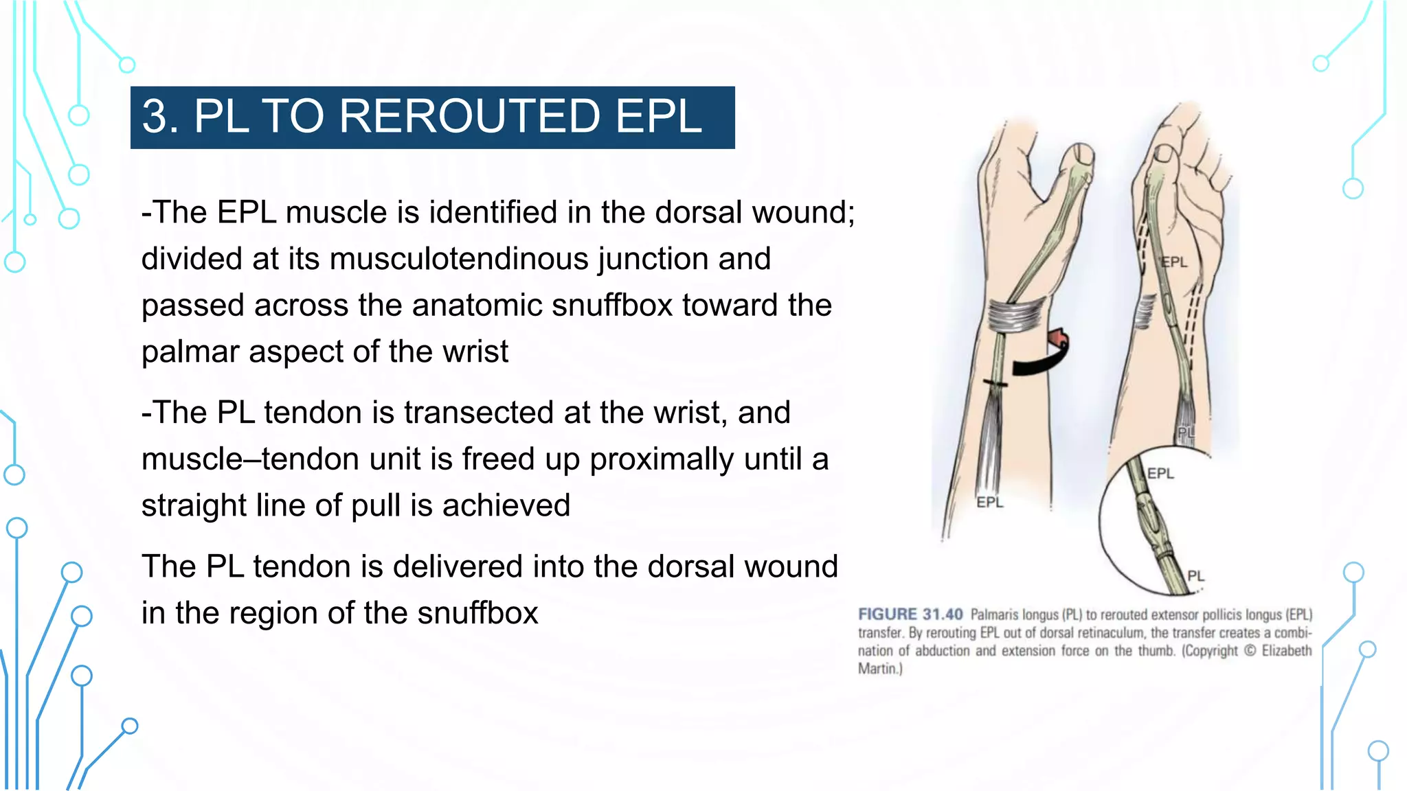3. PL TO REROUTED EPL
-The EPL muscle is identified in the dorsal wound;
divided at its musculotendinous junction and
passed across the anatomic snuffbox toward the
palmar aspect of the wrist
-The PL tendon is transected at the wrist, and
muscle–tendon unit is freed up proximally until a
straight line of pull is achieved
The PL tendon is delivered into the dorsal wound
in the region of the snuffbox.
 