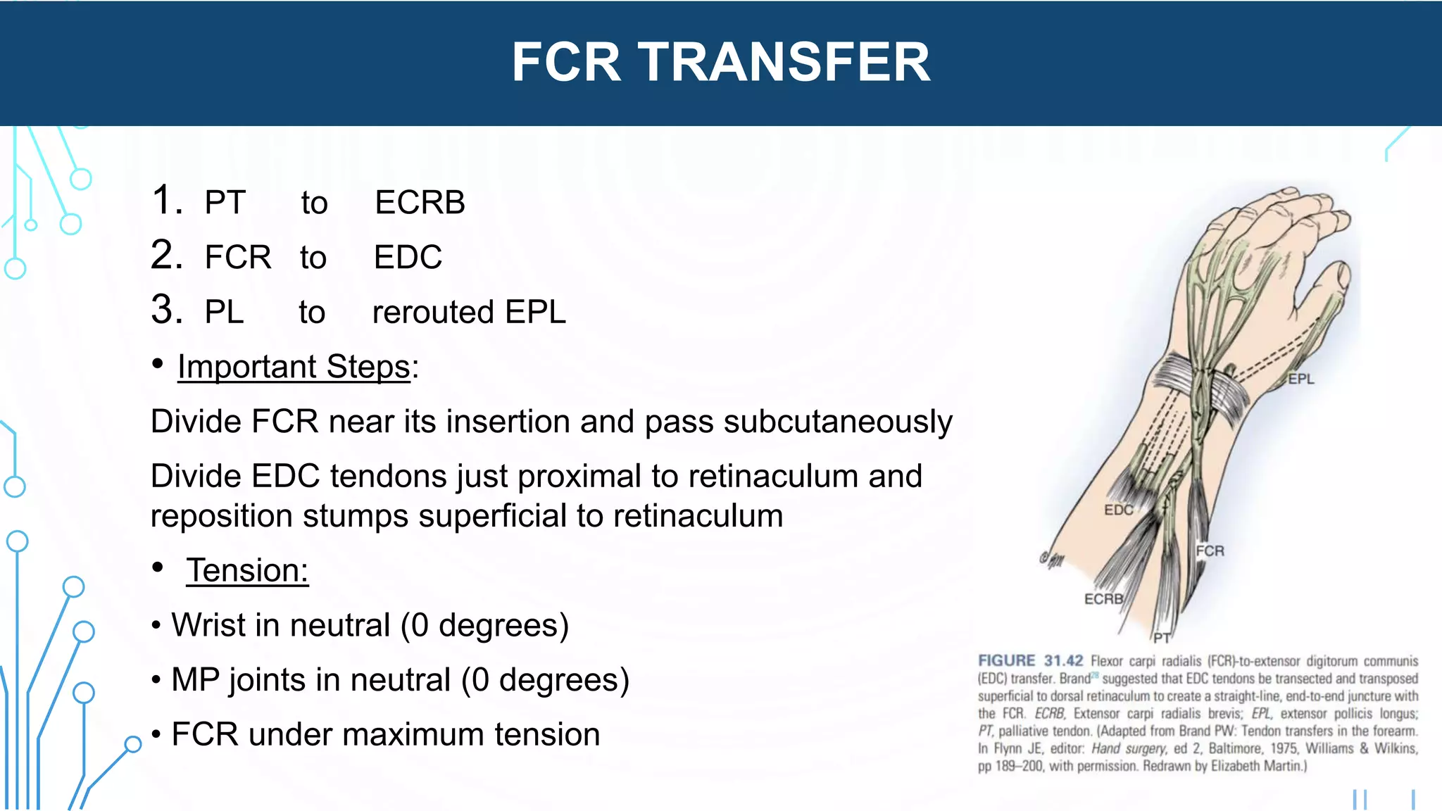 FCR TRANSFER
1. PT to ECRB
2. FCR to EDC
3. PL to rerouted EPL
• Important Steps:
Divide FCR near its insertion and pass subcutaneously
Divide EDC tendons just proximal to retinaculum and
reposition stumps superficial to retinaculum
• Tension:
• Wrist in neutral (0 degrees)
• MP joints in neutral (0 degrees)
• FCR under maximum tension
 