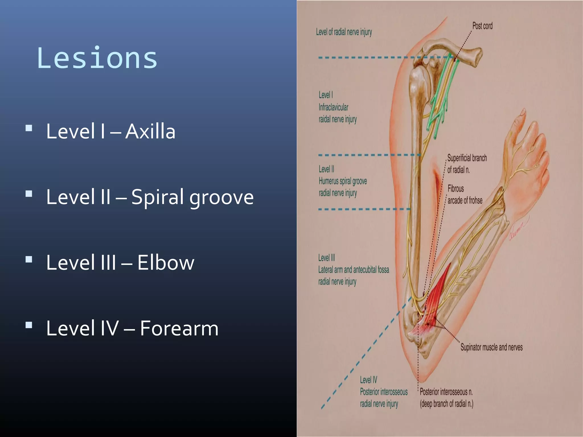 Lesions
 Level I – Axilla
 Level II – Spiral groove
 Level III – Elbow
 Level IV – Forearm
 