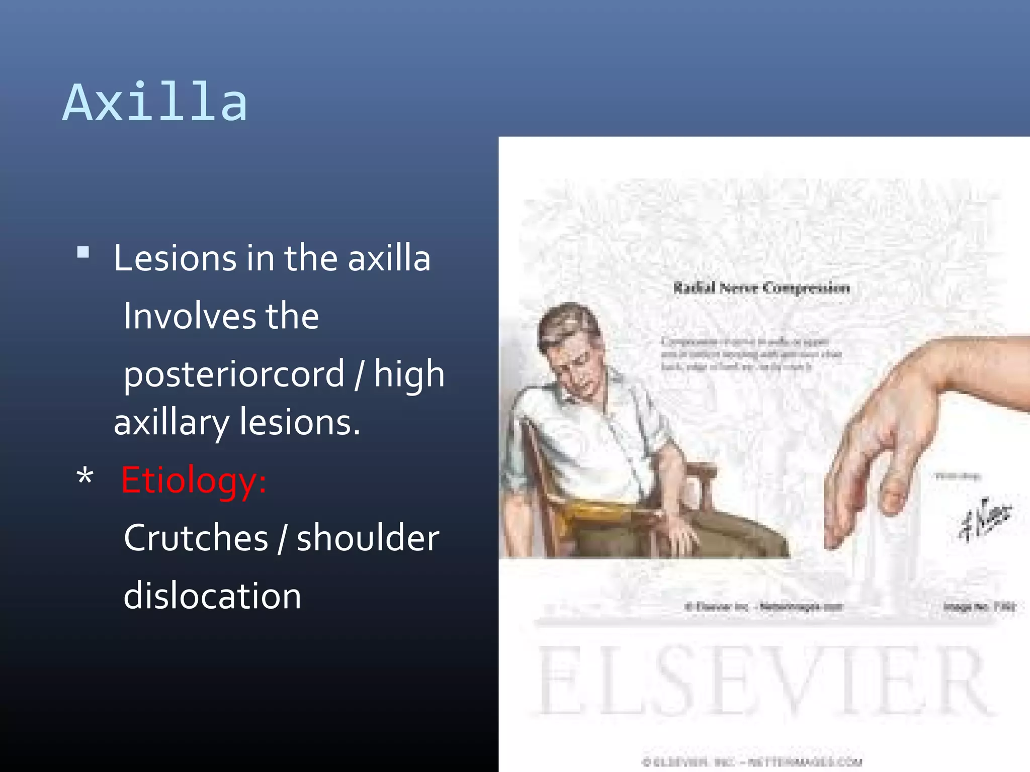 Axilla
 Lesions in the axilla
Involves the
posteriorcord / high
axillary lesions.
* Etiology:
Crutches / shoulder
dislocation
 