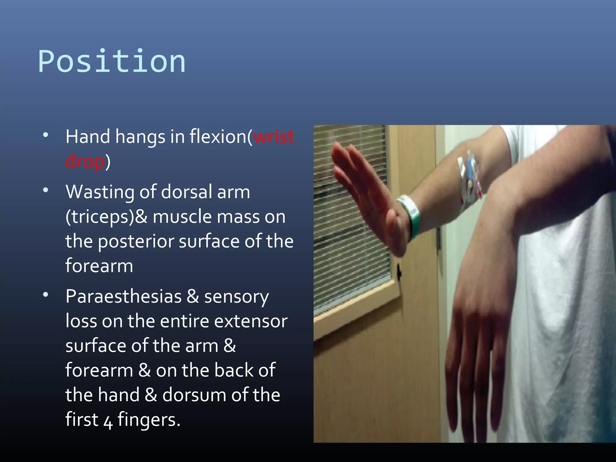 Position
• Hand hangs in flexion(wrist
drop)
• Wasting of dorsal arm
(triceps)& muscle mass on
the posterior surface of the
forearm
• Paraesthesias & sensory
loss on the entire extensor
surface of the arm &
forearm & on the back of
the hand & dorsum of the
first 4 fingers.
 