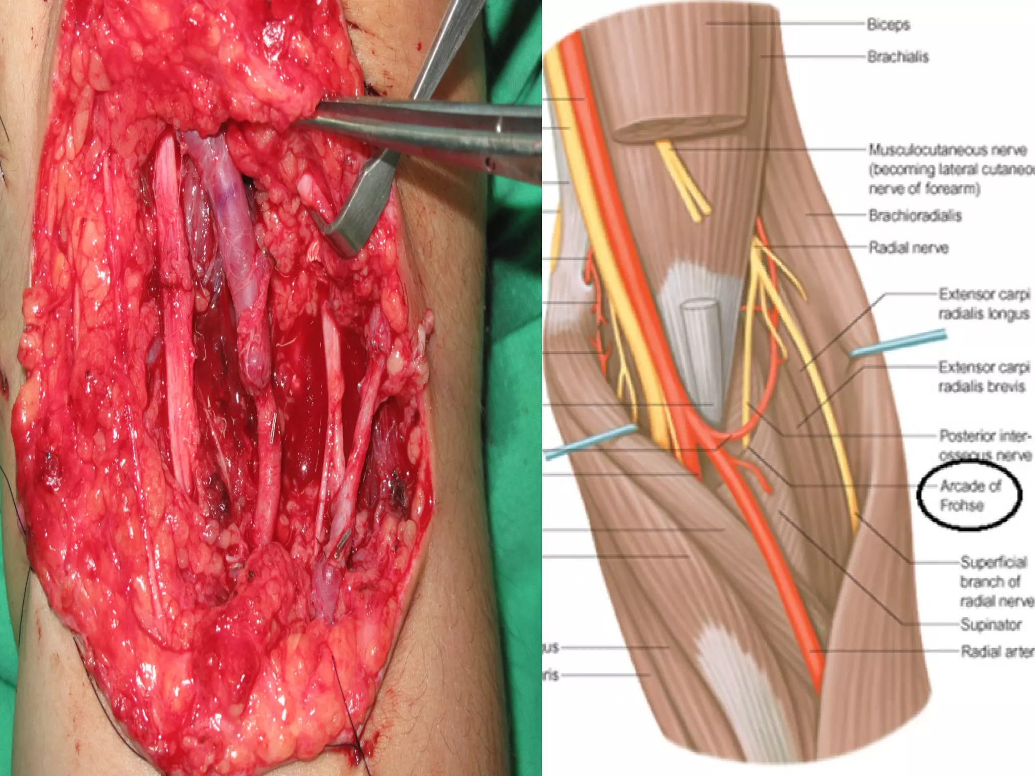 Radial nerve - Course & Relations / Applied Anatomy 