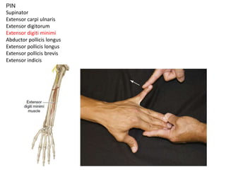 PIN
Supinator
Extensor carpi ulnaris
Extensor digitorum
Extensor digiti minimi
Abductor pollicis longus
Extensor pollicis longus
Extensor pollicis brevis
Extensor indicis
 