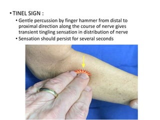 •TINEL SIGN :
• Gentle percussion by finger hammer from distal to
proximal direction along the course of nerve gives
transient tingling sensation in distribution of nerve
• Sensation should persist for several seconds
 