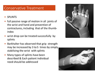  SPLINTS
 full passive range of motion in all joints of
the wrist and hand and prevention of
contractures, including that of the thumb-
index
 wrist drop can be treated successfully by
splints
 Barkhalter has observed that grip strength
may be increased by 3 to 5 times by simply
stabilizing the wrist with splints
 Many types of splints have been
described & Each patient individual
need should be addressed
Conservative Treatment
 
