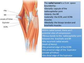 The radial tunnel is a 5cm space
bounded by:
▪Dorsally: capsule ofthe
radiocapitellar joint
▪Volarly: the BR
▪Laterally: the ECRL and ECRB
muscles
▪Medially: the biceps tendon and
brachialis muscles
Within radial tunnel, there are5
potential sites of compression:
▪fibrous bands to the radiocapitellar joint
between the brachialis and BR
▪the recurrent radial vessels
(leash of Henry)
▪the proximal edge of the ECRB
▪the proximal edge of the Supinator
(arcade ofFröhse)
▪the distal edge of theSupinator
BR
arcade of Fröhse
Supinator
ECRL
PIN
 