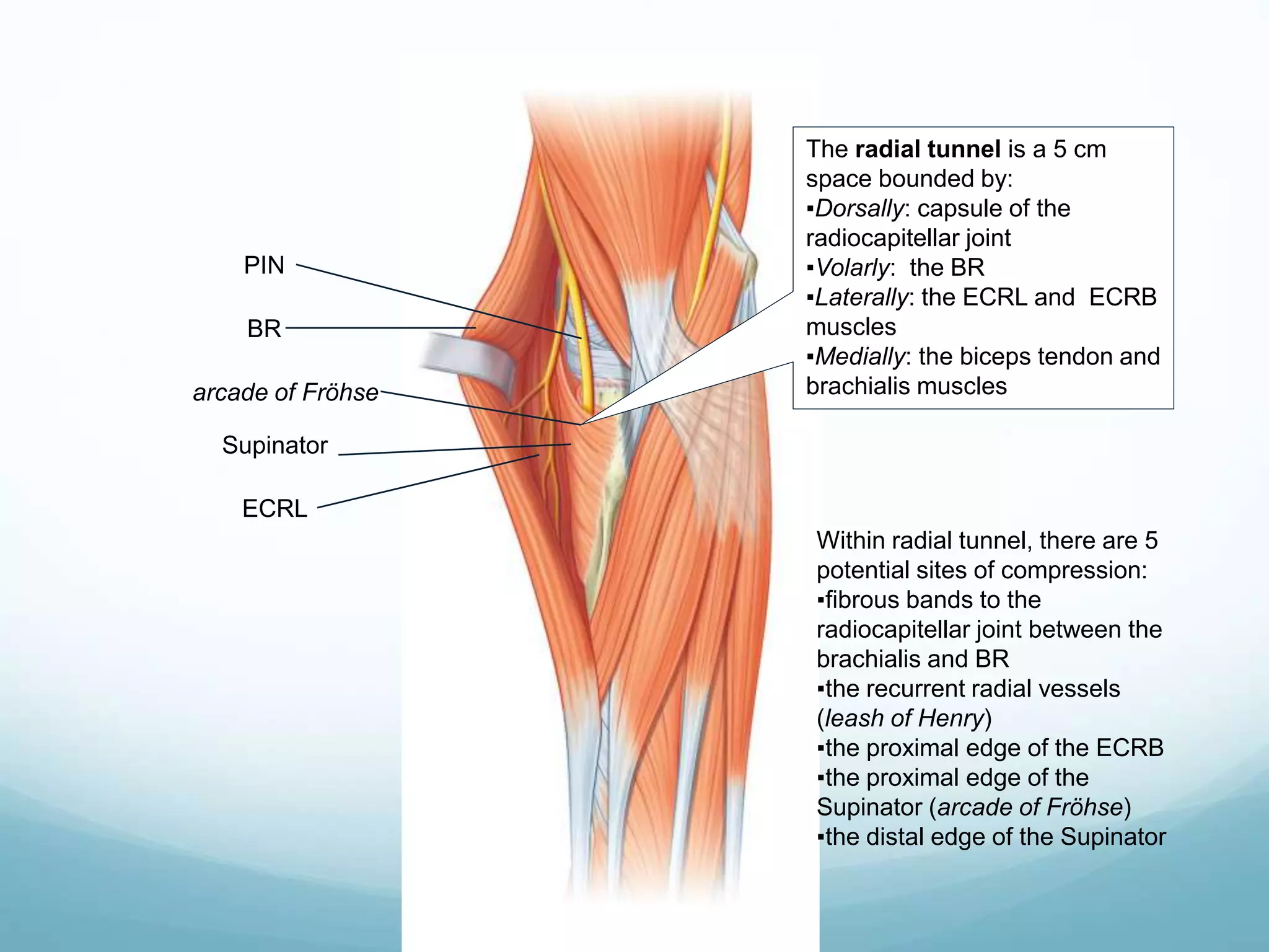 The radial tunnel is a 5 cm
space bounded by:
▪Dorsally: capsule of the
radiocapitellar joint
▪Volarly: the BR
▪Laterally: the ECRL and ECRB
muscles
▪Medially: the biceps tendon and
brachialis muscles
Within radial tunnel, there are 5
potential sites of compression:
▪fibrous bands to the
radiocapitellar joint between the
brachialis and BR
▪the recurrent radial vessels
(leash of Henry)
▪the proximal edge of the ECRB
▪the proximal edge of the
Supinator (arcade of Fröhse)
▪the distal edge of the Supinator
BR
Supinator
arcade of Fröhse
ECRL
PIN
 