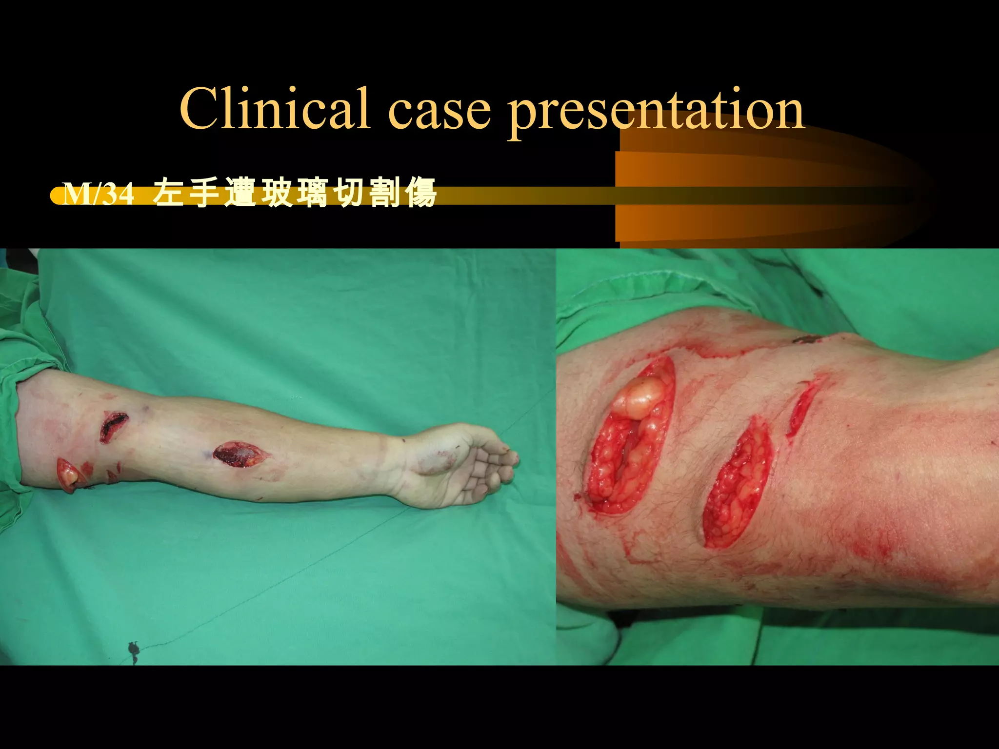 Clinical case presentation
M/34 左手遭玻璃切割傷
 