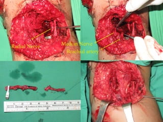 Radial Nerve   Median Nerve
                Brachial artery
 