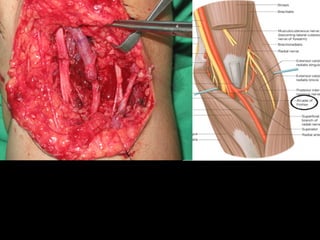 Radial nerve injury