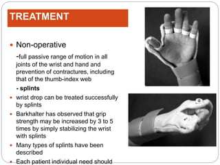 Radial nerve palsy | PPTX