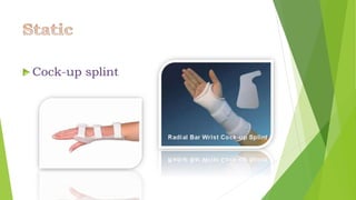 Rnp Splint Radial nerve palsy | PPTX