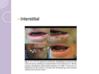 Radiation Intersititial Radiation Therapy | PPTX
