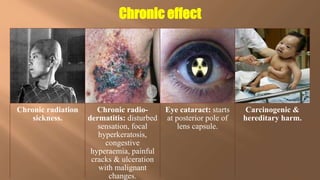 Chronic radiation
sickness.
Chronic radio-
dermatitis: disturbed
sensation, focal
hyperkeratosis,
congestive
hyperaemia, painful
cracks & ulceration
with malignant
changes.
Eye cataract: starts
at posterior pole of
lens capsule.
Carcinogenic &
hereditary harm.
Chronic effect
 