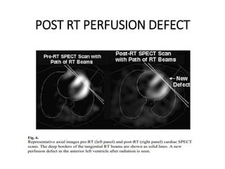 RADIATION INDUCED CARDIAC DISEASES | PPTX