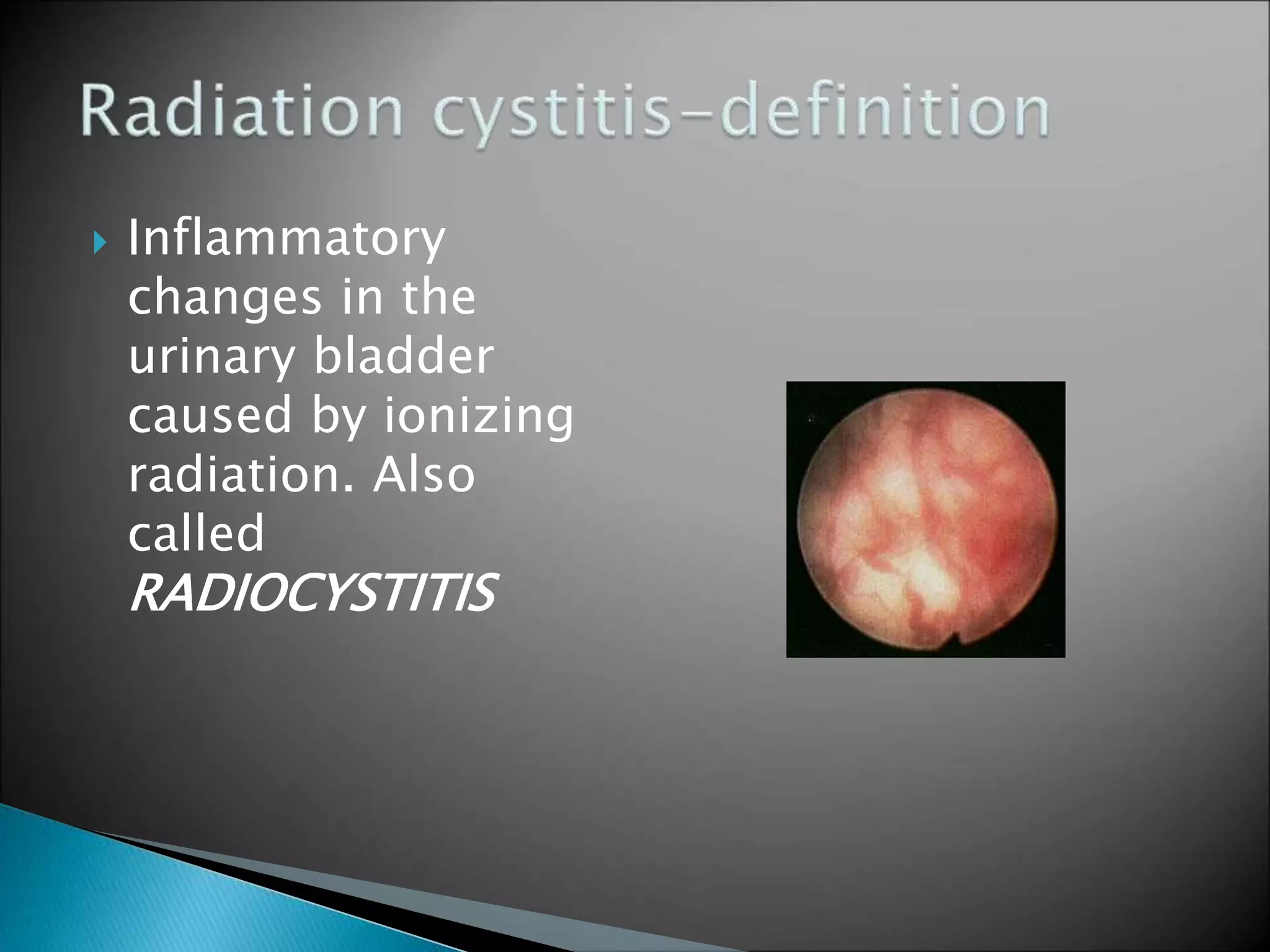 Radiation cystitis MANAGEMNT PPT