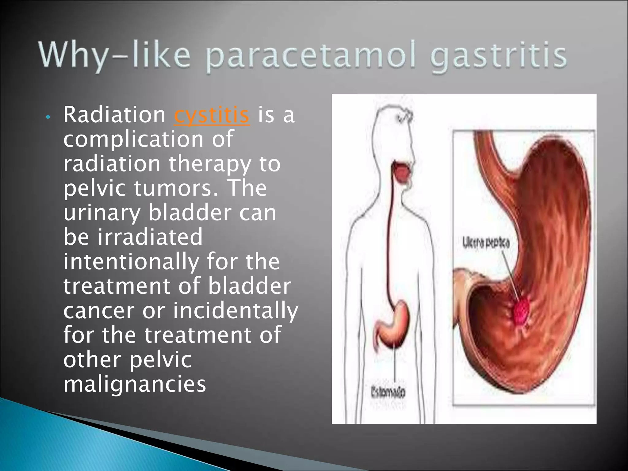 Radiation cystitis MANAGEMNT PPT