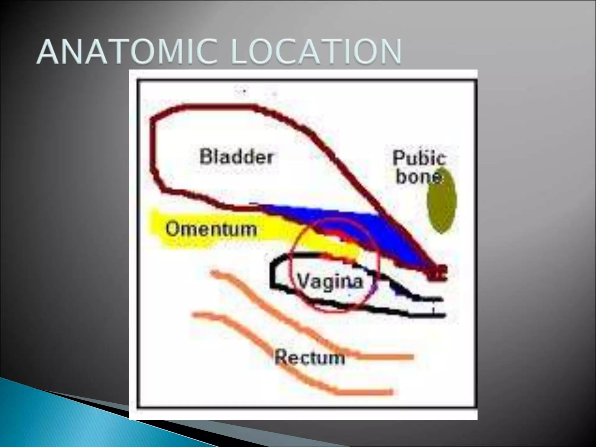 Radiation cystitis MANAGEMNT PPT