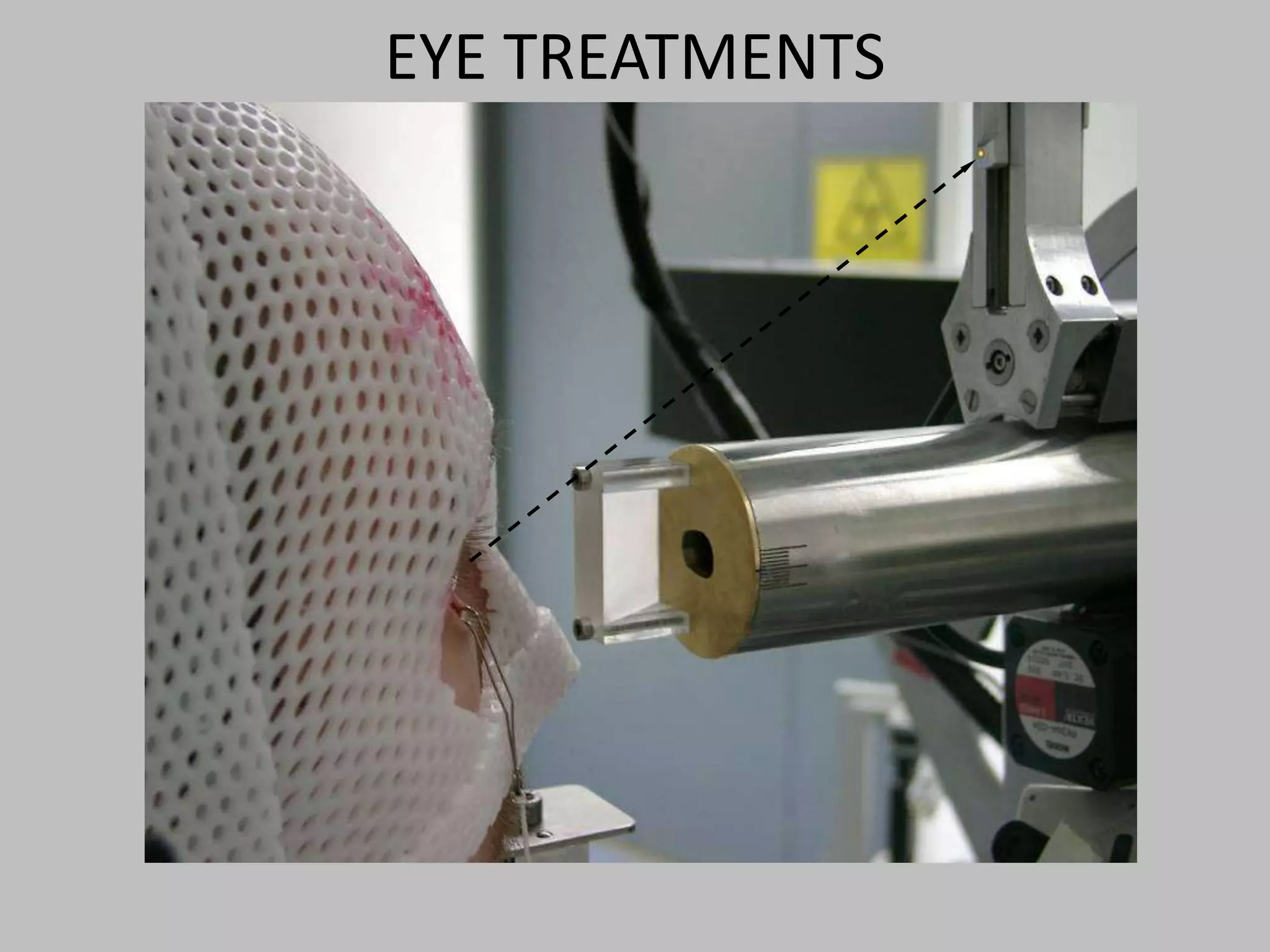 EYE TREATMENTS

      fixation light
 