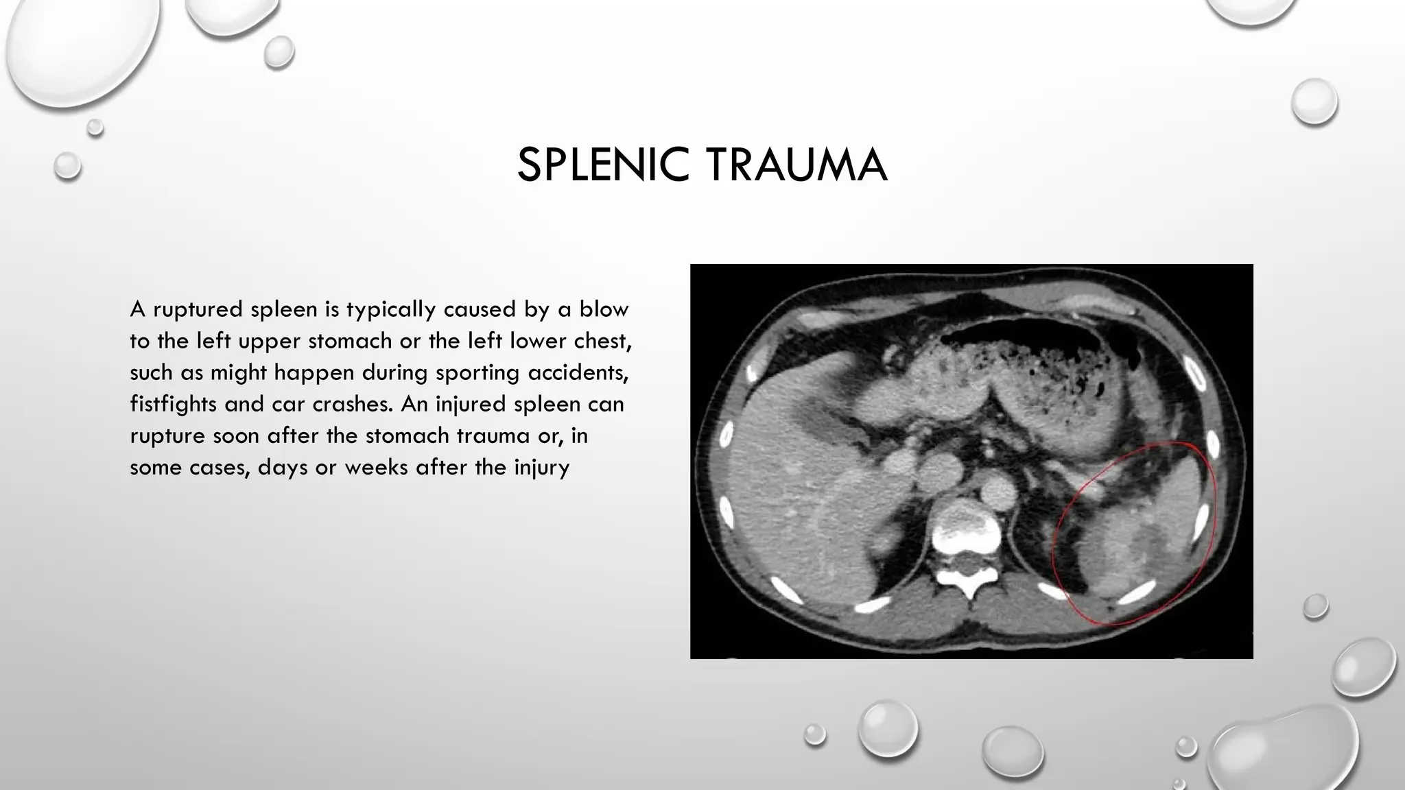 Spleen Rapture Radiation diagnostics of diseases of the thyroid gland (1).pptx